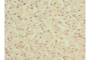 Immunohistochemistry of paraffin-embedded human liver cancer using ABIN7157915 at dilution of 1:100