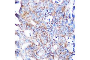 Immunohistochemistry of paraffin-embedded human breast cancer using Flotillin 1 Rabbit mAb (ABIN3017206, ABIN3017207, ABIN1680028 and ABIN1680029) at dilution of 1:100 (40x lens). (Flotillin 1 anticorps)
