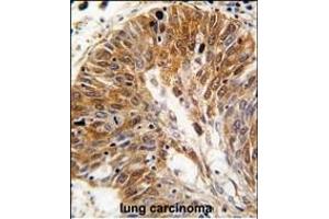 Formalin-fixed and paraffin-embedded human lung carcinoma tissue reacted with PSMD11 antibody (C-term), which was peroxidase-conjugated to the secondary antibody, followed by DAB staining. (PSMD11 anticorps  (C-Term))