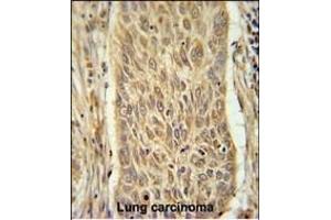 INMT Antibody (Center) (ABIN651667 and ABIN2840351) immunohistochemistry analysis in formalin fixed and paraffin embedded human lung carcinoma followed by peroxidase conjugation of the secondary antibody and DAB staining. (INMT anticorps  (AA 101-128))