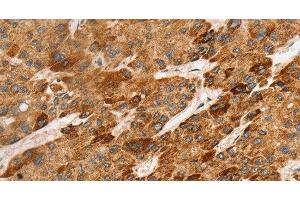 Immunohistochemistry of paraffin-embedded Human liver cancer tissue using LTB Polyclonal Antibody at dilution 1:45 (LTB anticorps)