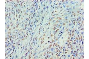 Immunohistochemistry of paraffin-embedded human breast cancer using ABIN7160405 at dilution of 1:100 (MYEF2 anticorps  (AA 372-576))