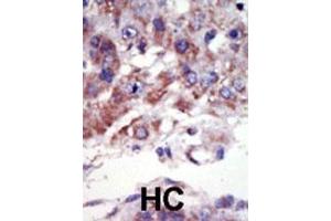Formalin-fixed and paraffin-embedded human cancer tissue reacted with the primary antibody, which was peroxidase-conjugated to the secondary antibody, followed by AEC staining. (JNK2 anticorps  (C-Term))