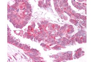 Anti-TRPM4 antibody IHC of human Ovary, Carcinoma.