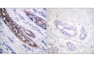 Immunohistochemistry analysis of paraffin-embedded human breast carcinoma tissue, using IRAK1 (Ab-209) Antibody. (IRAK1 anticorps  (AA 175-224))