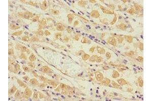 Immunohistochemistry of paraffin-embedded human gastric cancer using ABIN7173562 at dilution of 1:100 (Tropomyosin 4 anticorps  (AA 1-248))