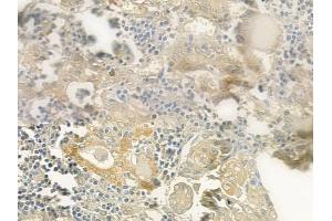 ABIN6265252 and ABIN6277103 at 1/100 staining human thyroid carcinoma by IHC-P.