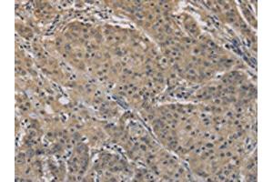 The image on the left is immunohistochemistry of paraffin-embedded Human gastric cancer tissue using ABIN7128303(AGTRAP Antibody) at dilution 1/40, on the right is treated with fusion protein. (AGTRAP anticorps)