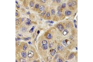 Immunohistochemical analysis of PYGB staining in human liver cancer formalin fixed paraffin embedded tissue section. (PYGB anticorps)