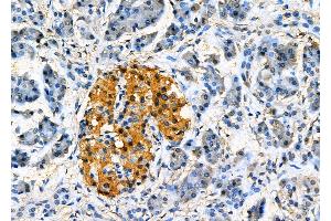 ABIN6265623 and ABIN6277829 at 1/100 staining Human pancreatic cancer and adjacent nomal tissues by IHC-P.