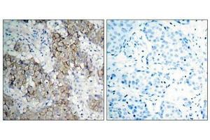 Immunohistochemical analysis of paraffin- embedded human breast carcinoma tissue using IGF-1R (phospho-Tyr1161) antibody.