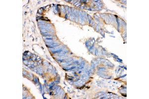 Anti- HRG antibody, IHC(P) IHC(P): Human Intestinal Cancer Tissue (HRG anticorps  (AA 19-200))