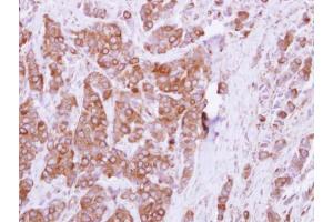 IHC-P Image Immunohistochemical analysis of paraffin-embedded human breast cancer, using OCRL, antibody at 1:250 dilution. (OCRL anticorps  (C-Term))
