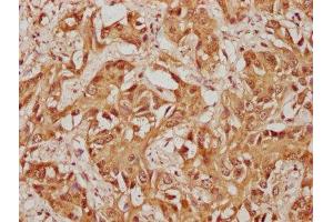 IHC image of ABIN7174320 diluted at 1:100 and staining in paraffin-embedded human liver cancer performed on a Leica BondTM system. (USP36 anticorps  (AA 670-881))