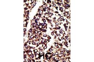 Formalin-fixed and paraffin-embedded human hepatocellular carcinoma tissue reacted with AGER polyclonal antibody  , which was peroxidase-conjugated to the secondary antibody, followed by AEC staining . (RAGE anticorps  (C-Term))