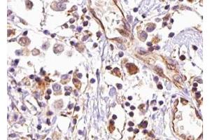 ABIN6267475 at 1/100 staining human breast carcinoma tissue sections by IHC-P. (AKT2 anticorps  (pSer474))