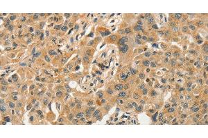 Immunohistochemistry of paraffin-embedded Human lung cancer tissue using SLC11A2 Polyclonal Antibody at dilution 1:50 (SLC11A2 anticorps)