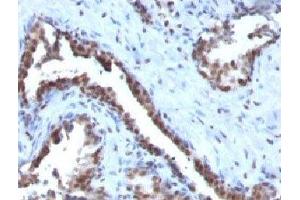 Formalin-fixed, paraffin-embedded human prostate carcinoma stained with Cyclin B1 antibody.
