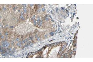 ABIN6272911 at 1/100 staining Human prostate tissue by IHC-P. (Choline Kinase alpha anticorps  (Internal Region))