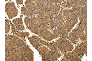 The image on the left is immunohistochemistry of paraffin-embedded Human liver cancer tissue using ABIN7129340(EIF2AK3 Antibody) at dilution 1/40, on the right is treated with fusion protein.