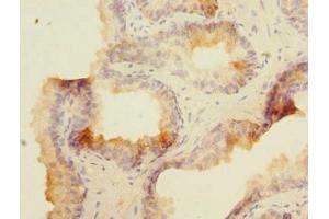 Immunohistochemistry of paraffin-embedded human prostate cancer using ABIN7160074 at dilution of 1:100 (MAP4K5 anticorps  (AA 300-480))