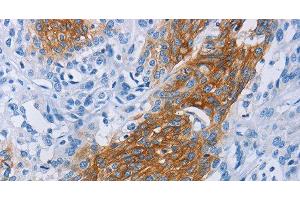 Immunohistochemistry of paraffin-embedded Human esophagus cancer tissue using CCR9 Polyclonal Antibody at dilution 1:60 (CCR9 anticorps)