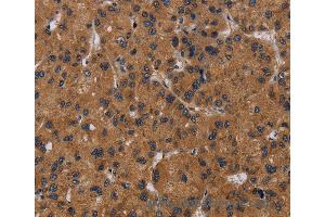 Immunohistochemistry of Human thyroid cancer using NPRL2 Polyclonal Antibody at dilution of 1:50 (NPRL2 anticorps)