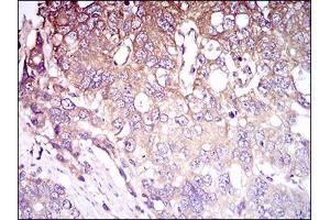 Immunohistochemical analysis of paraffin-embedded esophageal cancer tissues using CD93 mouse mAb with DAB staining. (CD93 anticorps  (AA 474-535))