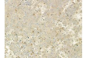 ABIN6264150 and ABIN6277603 at 1/100 staining human melanoma by IHC-P.