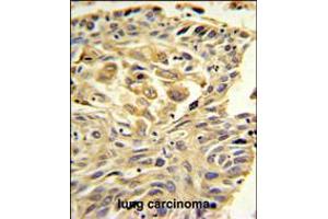ZO1 Antibody IHC analysis in formalin fixed and paraffin embedded lung carcinoma followed by peroxidase conjugation of the secondary antibody and DAB staining. (TJP1 anticorps  (C-Term))
