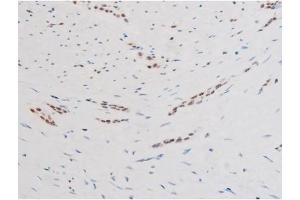 ABIN6267579 at 1/200 staining Human bladder cancer tissue sections by IHC-P. (FOXO4 anticorps  (pSer197))