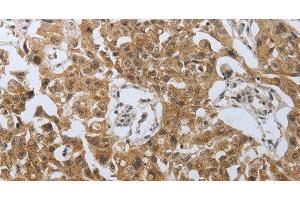Immunohistochemistry of paraffin-embedded Human lung cancer using PSMD6 Polyclonal Antibody at dilution of 1:40 (PSMD6 anticorps)