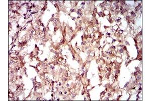 Immunohistochemical analysis of paraffin-embedded renal cancer tissues using GUCY1A3 mouse mAb with DAB staining. (GUCY1A1 anticorps  (AA 22-214))