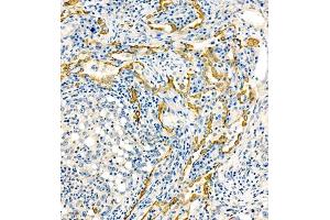 Immunohistochemistry of paraffin embedded human lung cancer using MRP1 (ABIN7074544) at dilution of 1:1000 (200x lens) (MRP1 anticorps)
