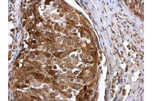 IHC-P Image IFIT3 antibody detects IFIT3 protein at cytoplasm in human cervical carcinoma by immunohistochemical analysis. (IFIT3 anticorps)