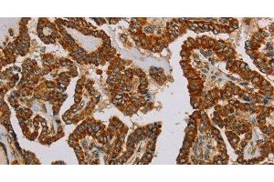 Immunohistochemistry of paraffin-embedded Human thyroid cancer using NDUFS5 Polyclonal Antibody at dilution of 1:50 (NDUFS5 anticorps)