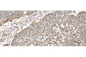 Immunohistochemistry of paraffin-embedded Human lung cancer tissue using DPH7 Polyclonal Antibody at dilution of 1:40(x200) (Diphthamide Biosynthesis 7 (DPH7) anticorps)