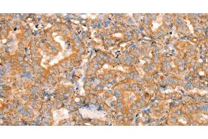 Immunohistochemistry of paraffin-embedded Human thyroid cancer using SLC16A8 Polyclonal Antibody at dilution of 1:40 (MCT3 anticorps)