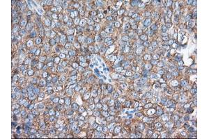 Immunohistochemical staining of paraffin-embedded Adenocarcinoma of Human colon tissue using anti-EIF2S1 mouse monoclonal antibody. (EIF2S1 anticorps)