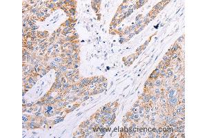 Immunohistochemistry of Human esophagus cancer using GFRA3 Polyclonal Antibody at dilution of 1:60 (GFRA3 anticorps)