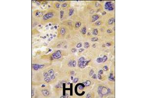Formalin-fixed and paraffin-embedded human hepatocarcinoma tissue reacted with PFKFB1 antibody (N-term), which was peroxidase-conjugated to the secondary antibody, followed by DAB staining.