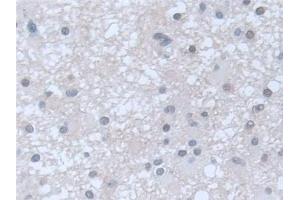 Detection of GUCY1b3 in Human Glioma Tissue using Polyclonal Antibody to Guanylate Cyclase 1 Beta 3 (GUCY1b3) (GUCY1B3 anticorps  (AA 408-619))