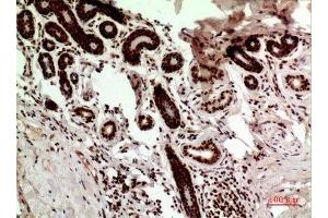 Immunohistochemistry (IHC) analysis of paraffin-embedded Human Breast Cancer, antibody was diluted at 1:100. (p53 anticorps  (Internal Region))