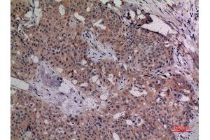 Immunohistochemistry (IHC) analysis of paraffin-embedded Human Breast Cancer, antibody was diluted at 1:100. (IL-4 anticorps  (Internal Region))
