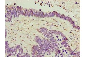 Immunohistochemistry of paraffin-embedded human ovarian cancer using ABIN7174864 at dilution of 1:100 (C6orf141 anticorps  (AA 1-237))