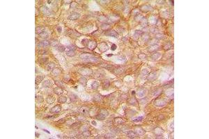Immunohistochemical analysis of LYN staining in human breast cancer formalin fixed paraffin embedded tissue section.