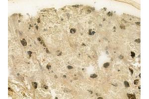 ABIN6257412 and ABIN6275533 at 1/100 staining human melanoma by IHC-P.