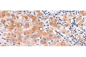 Immunohistochemistry of paraffin-embedded Human liver cancer tissue using ITGA11 Polyclonal Antibody at dilution of 1:75(x200)