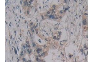 Detection of MPG1 in Human Pancreatic cancer Tissue using Polyclonal Antibody to Macrophage Expressed Gene 1 Protein (MPG1) (MPEG1 anticorps  (AA 313-580))