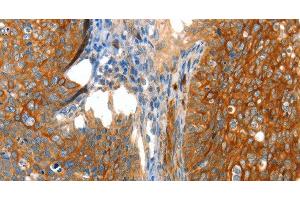 Immunohistochemistry of paraffin-embedded Human cervical cancer tissue using VWA5A Polyclonal Antibody at dilution 1:80
